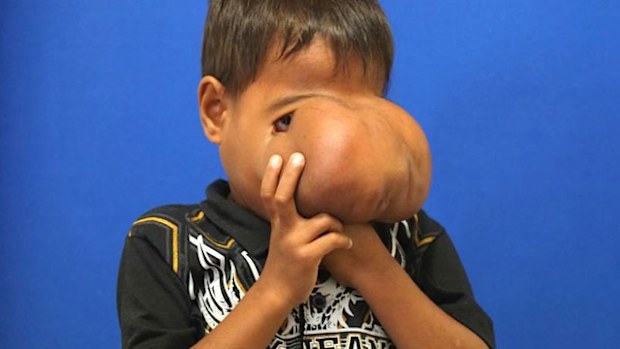 Seven-year-old Jhonny Lameon has undergone surgery to remove a growth on his face. (Monash Health)