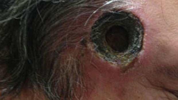 A 55-year-old man was left with an inch-wide hole in his head after trying to treat what he thought was cancer. (Photo: Supplied)