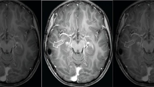The tumour found in the girl's brain. (ecancermedicalscience)