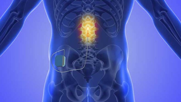 An image showing what a spinal cord stimulator would look like when inserted into a patient.