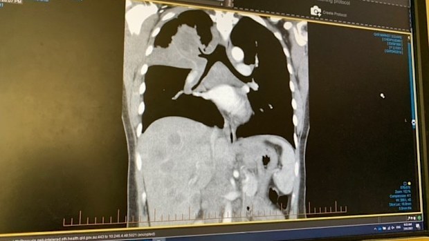 The cancer has spread to Ms Chen's liver, heart and bones.