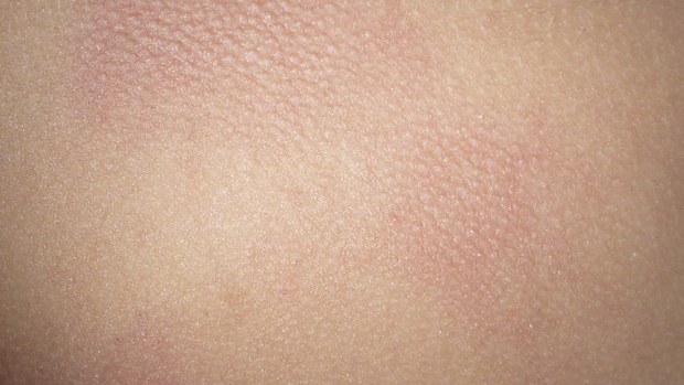 Despite the extreme pain they cause Irukandji stings leave relatively delicate marks.