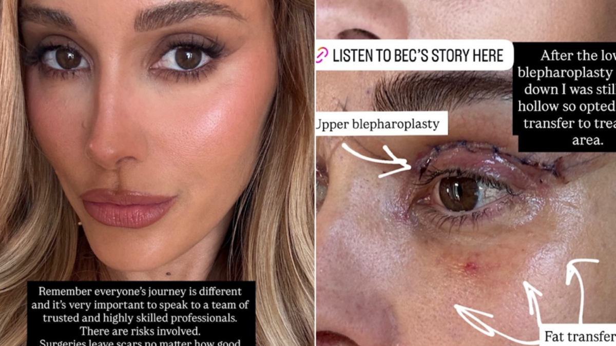 Bec Judd plastic surgery: Star shares graphic photos from eye procedure ...