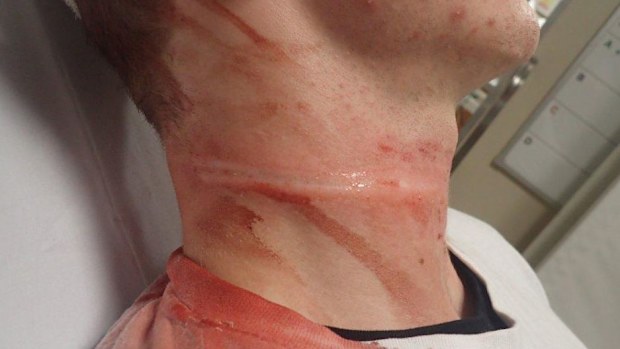 Lawson Mills suffered rope burns to his neck.