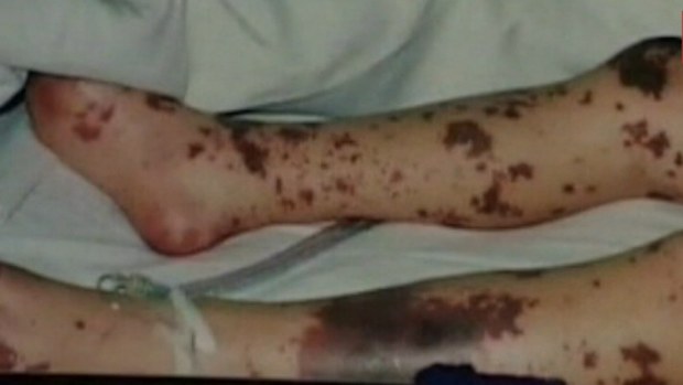Meningococcal Disease B Strain research