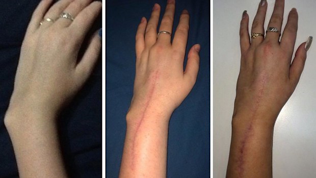 Sharyce Helyar captioned this photo on Instagram: "It is amazing what 2 operations, 15 screws and 2 titanium plates can do! I'm so glad my wrist doesn't look like that anymore!"