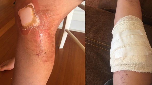 Festivalgoer Olivia Jones' injured leg as a result of Friday night's crush.