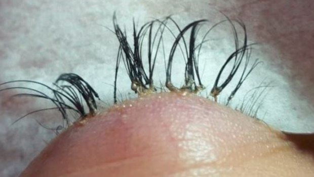 The infected lashes.