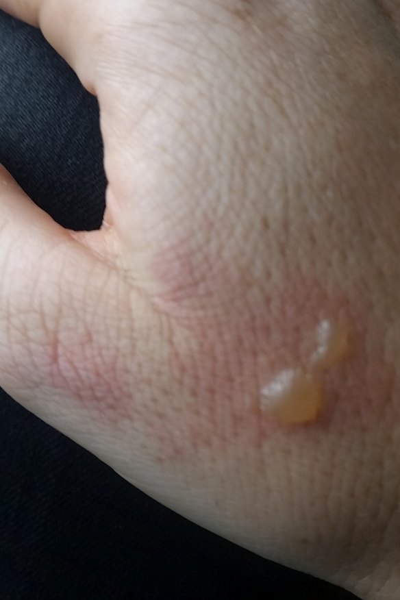 The woman's hand was also burnt.