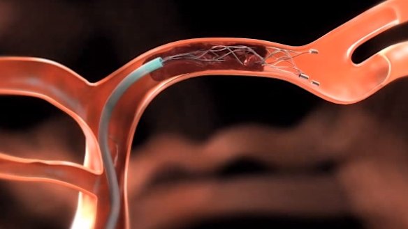 Lives could be saved with access to clot-buster device: expert