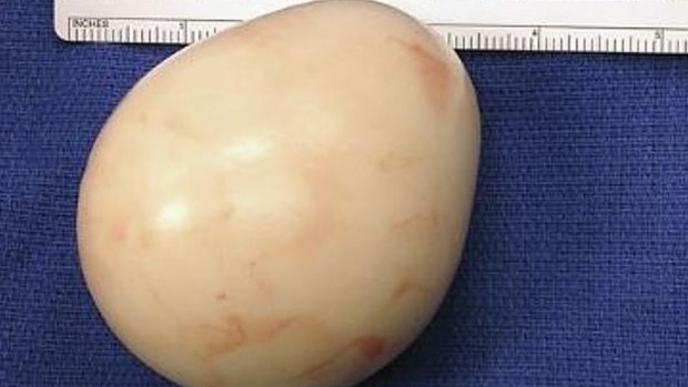 The lump, which resembles a boiled egg, found inside the patient's stomach.