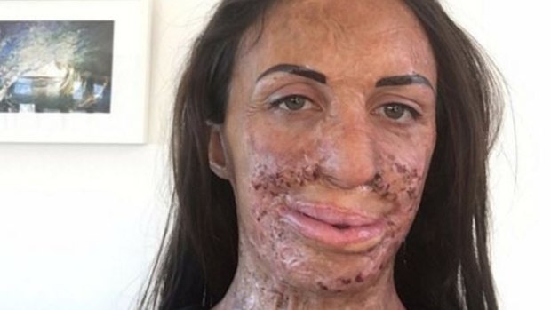 Turia Pitt had undergone more surgery for the injuries she sustained during an ultra marathon in 2011.