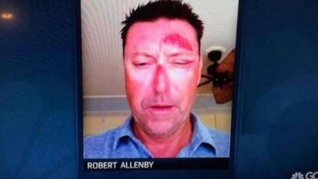 Robert Allenby posted an image of his battered face on Twitter in January.