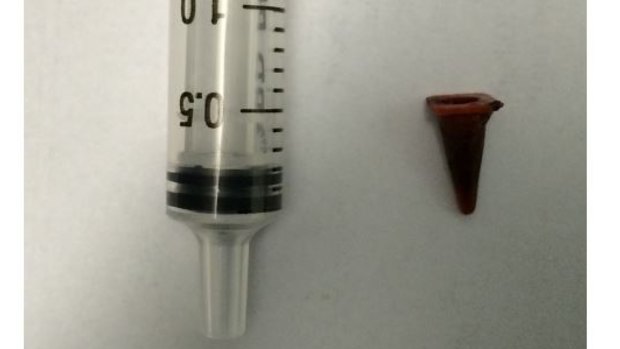 A Playmobil traffic cone that was lodged in a man's right lung, initially suspected of being cancer. 