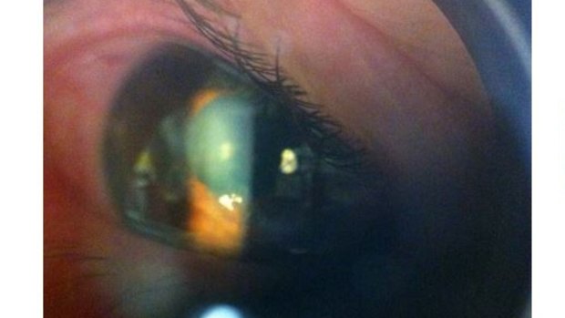 A lesion on a woman's cornea that turned out to be a piece of glitter form a Christmas card. 
