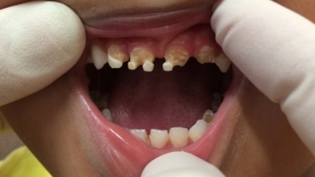 Decayed teeth