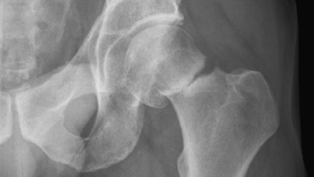 Hip fractures and other common breaks are predicted to increase with the ageing population. 