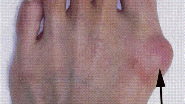 20 per cent of women aged over 65 suffer bunions.