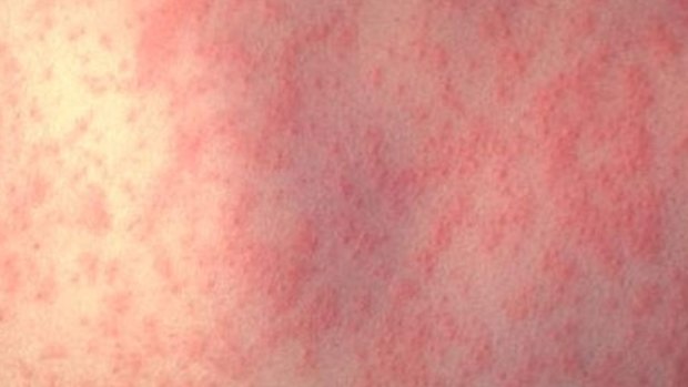 A case of measles. 
