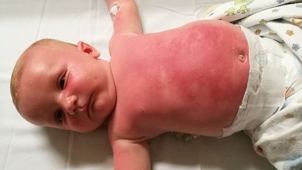 Jessie Swan posted to the Cancer Council Facebook page after her baby was hospitalised for an averse reaction to sunscreen.