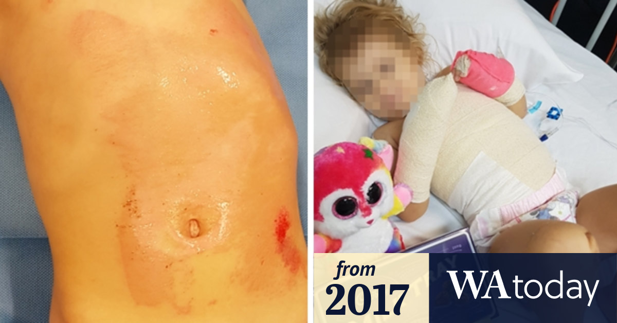 Three-year-old WA girl suffers horrific friction burns after treadmill  accident