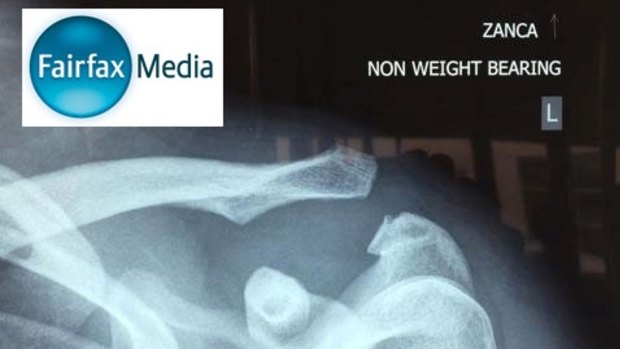 Revealed: The X-ray which shows the true extent of Farah's injury.
