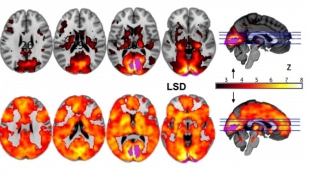 Research from Imperial College London, showing how, with eyes-closed, much more of the brain contributes to the visual experience under LSD (above) than under placebo (top).