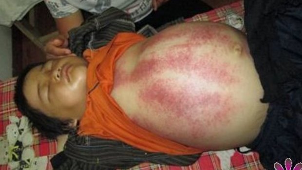 Mr Xiao's website claimed the bruises on this Nepalese eight-year-old were part of the healing process. 