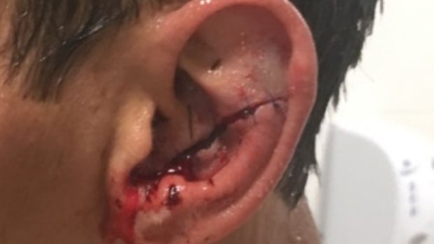 Lobe blow: Elijah Taylor needed eight stitches after clash with Sam Burgess.