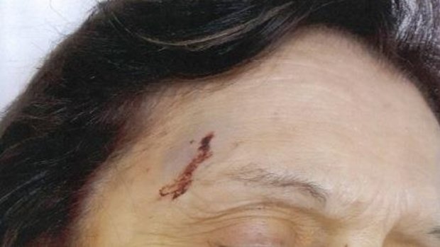 Nine days after she was set upon in a Brunswick toilet block, Maria has a large black and purple bruise on her forehead.