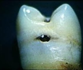 A cavity in a tooth. 