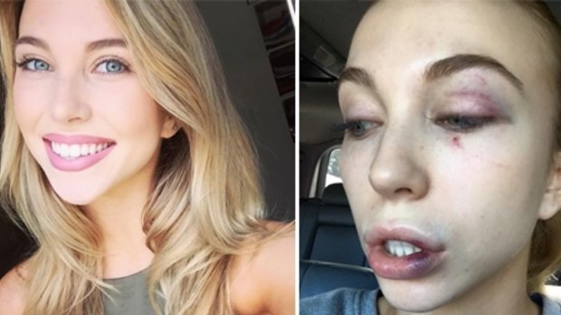 Model Elise Chambellant is still determined to compete in Miss Universe after her savage bashing.