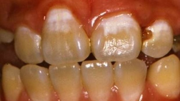 The white patches, such as those on the two front teeth, indicate decay that can be stopped. 