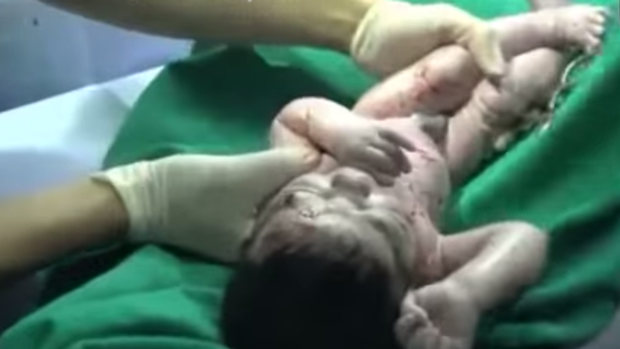 Doctors in Aleppo saved a baby girl after shrapnel that pierced her mother's belly became lodged in her forehead.