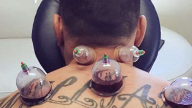 Treatment: Sonny Bill Williams receives hijama cupping therapy.