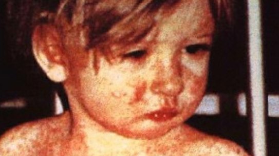 A child with a bad case of measles.
