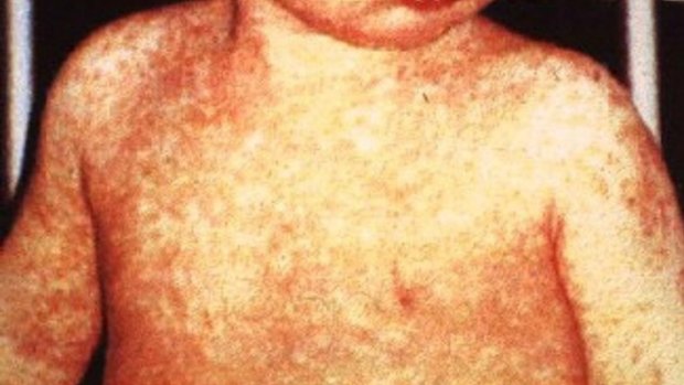 Measles can cause serious complications such as pneumonia and encephalitis.