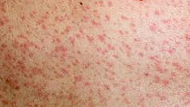 A case of measles.