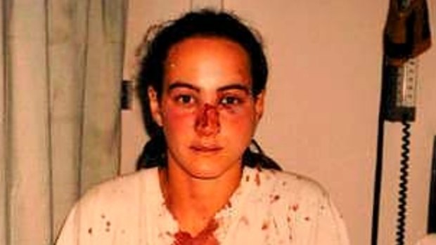 Corina Horvath after she was allegedly assaulted by police.