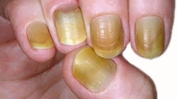 The man involved in the Bundoora attack had distinctive yellow nails like this.