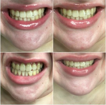 I Brushed My Teeth With Charcoal For Six Weeks Because A Facebook
