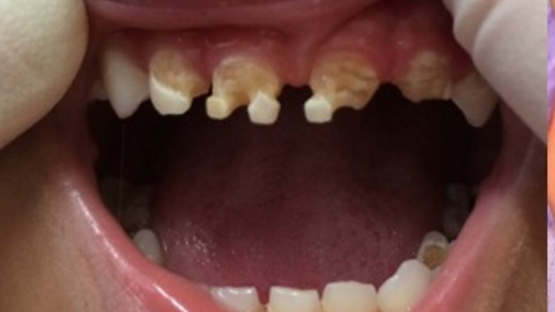 Kids as young as 18 months needing rotten teeth pulled because of