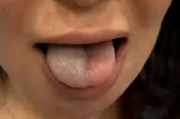 A vascular occlusion of the tongue posted to Fresh Clinics’ website by one of its doctors. The serious vascular occlusion – when blood flow to an artery is blocked – affected the patient’s chin and tongue due to a filler being injected into their chin. The patient recovered but the Fresh doctor said she “experienced extreme pain”.