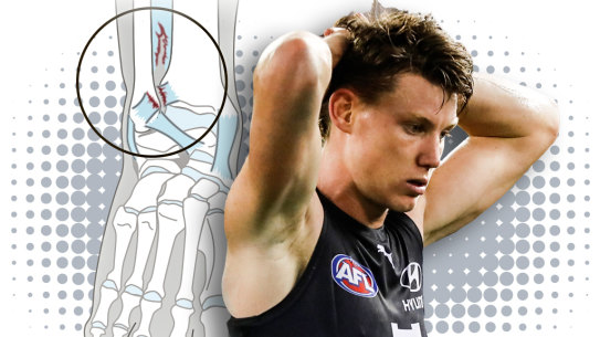 Composite image of a syndesmosis ankle injury and Carlton midfielder Sam Walsh.