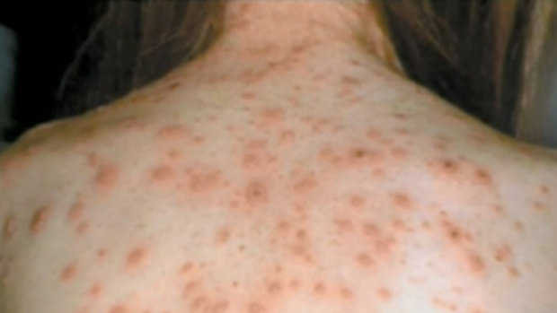 About 30 per cent of adults with measles will be hospitalised, according to Queensland Health. (File image)