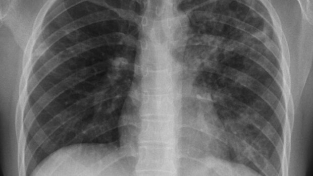 There are concerns people are at risk of undiagnosed lung cancer because they have been putting off visiting their GP during the pandemic.