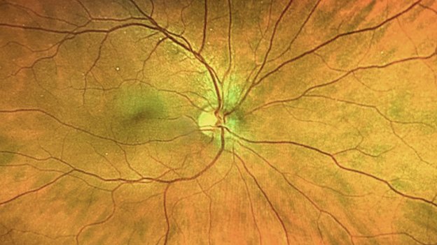 The human retina: End product of millions of years of evolution.