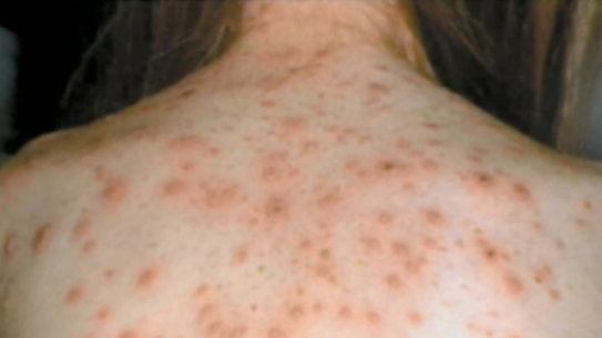 A measles alert has been issued for Perth's metropolitan area. 