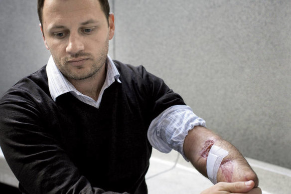 "The attack was just mathematical randomness" … Glenn Orgias, who lost his left hand after being bitten by a great white at Bondi in 2009.
