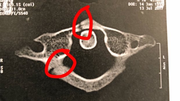 Near miss: An x-ray of Jaeman Salmon's broken neck.